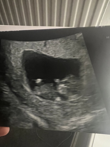 Nub theory 12 week scan