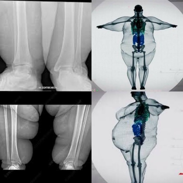 Limping, obese, middle aged woman in chronic pain seeks...