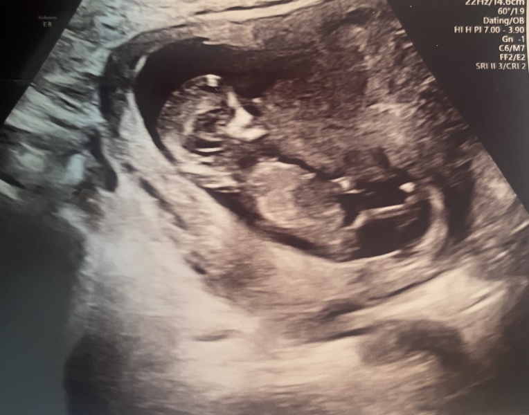 Guess baby’s gender from gender scan pic! 😍