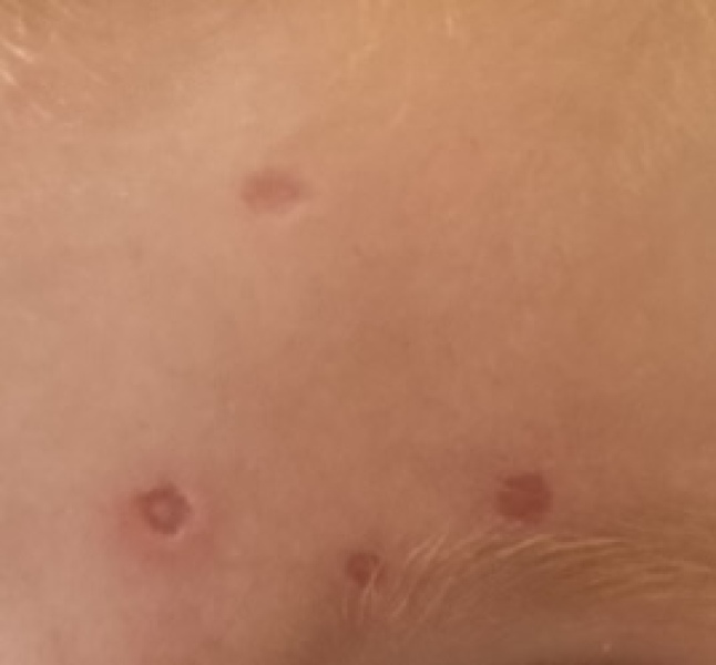 Large chicken pox scar