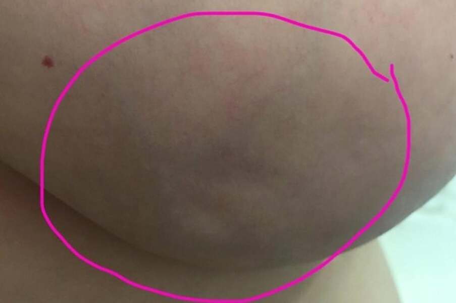 Breast dimple