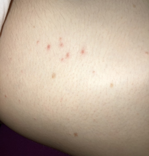 6 week old bite marks?
