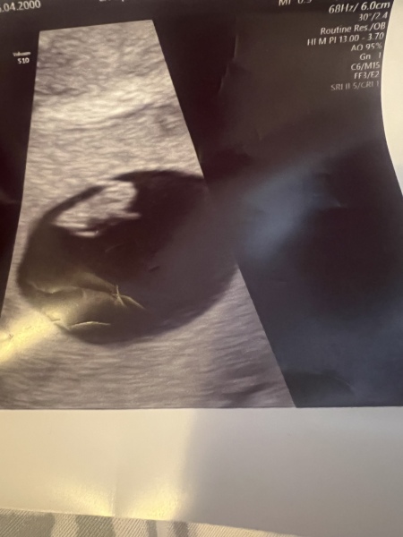 7 week scan