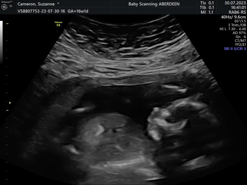 Pregnant after miscarriage - support thread NEW