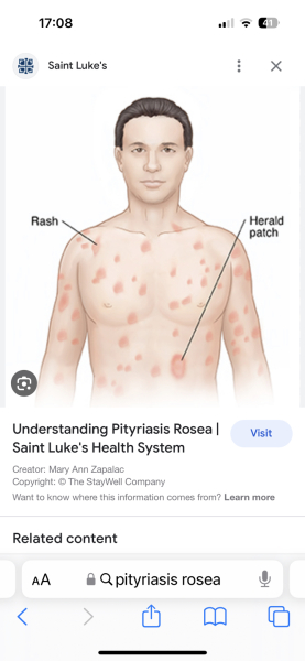 Mark on breast - what is it? Picture included 