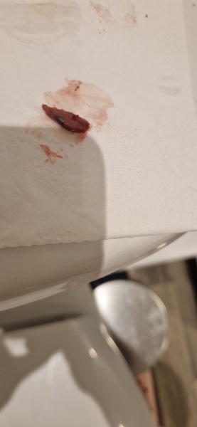 Miscarriage clots TW-pictures of clots!!! 