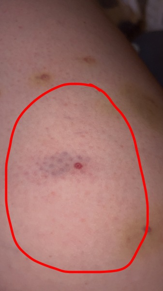 Fragmin injections