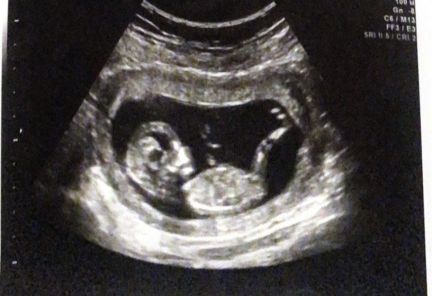 Nub theory! Ultrasound at 12w5d but measuring 13w2d!