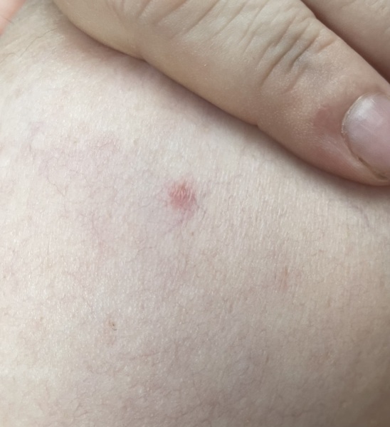 Small red mark on breast?
