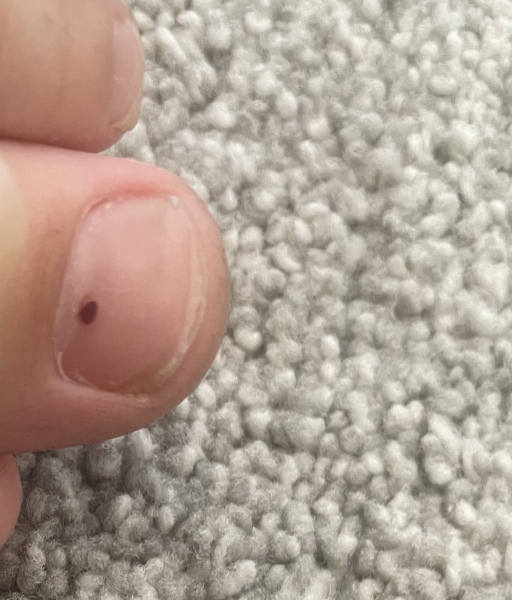 Freckle like mark under child’s toenail