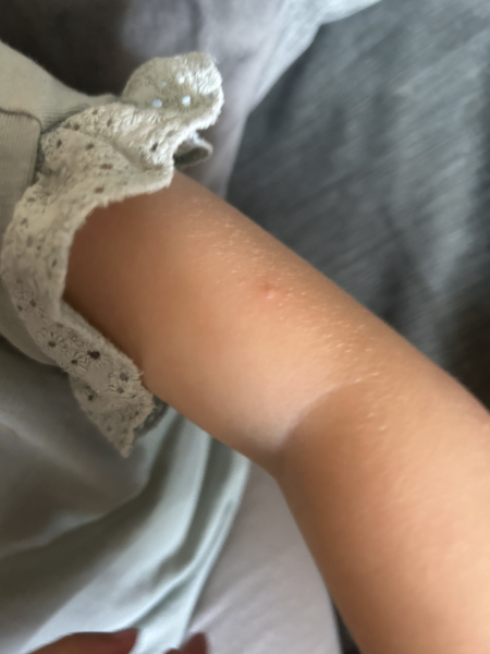 Spots on 2yo’s arm and legs