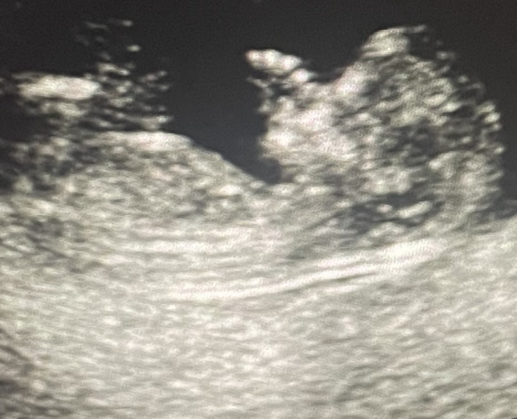 12 weeks ultrasound boy or girl?