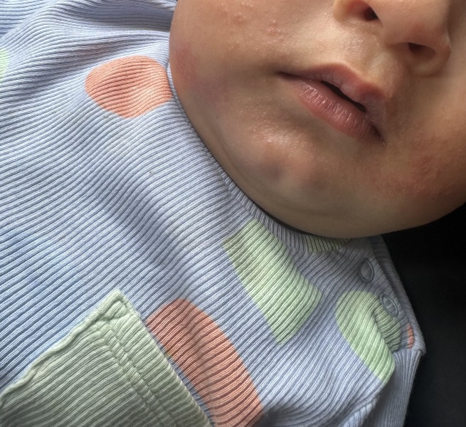What’s this rash on my 8 month old’s face?