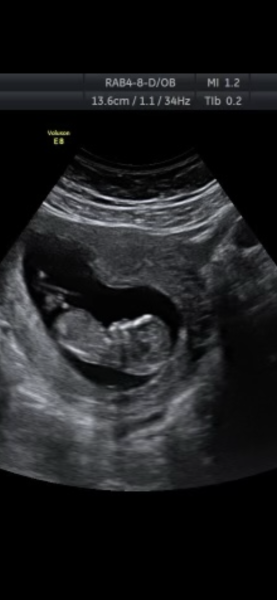 Boy or Girl?