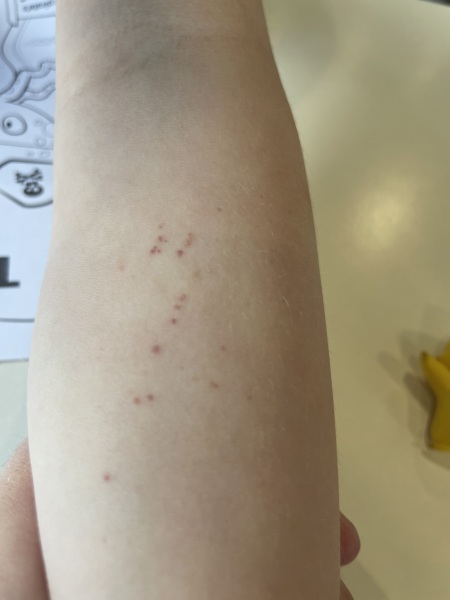 What could this rash be? Help please! 