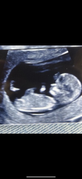 Gender at 14 weeks