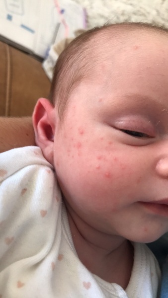 Worried.. is this baby acne?