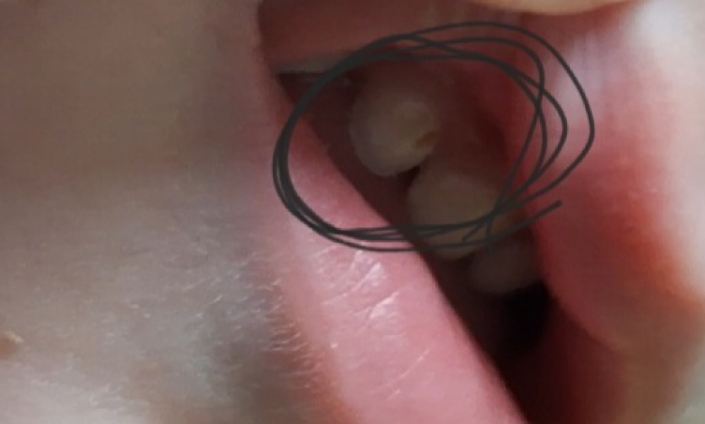 Is this tooth decay?