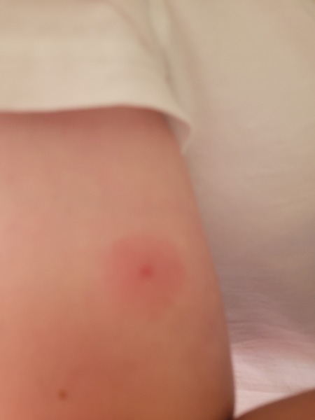 Will get checked tomorrow but could this be a tick bite? 