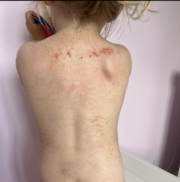 Heat rash??