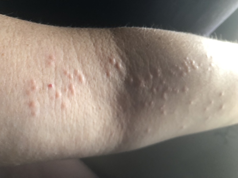 Any idea what this rash is?