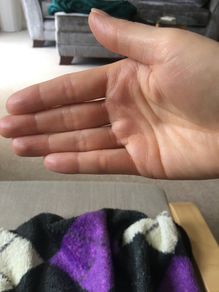 Pamela - Bile Duct Cancer, thread 4, London has given me a chance! 