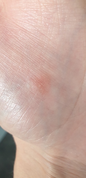 Wart help - using bazuka but it looks a bit wrong (photos)