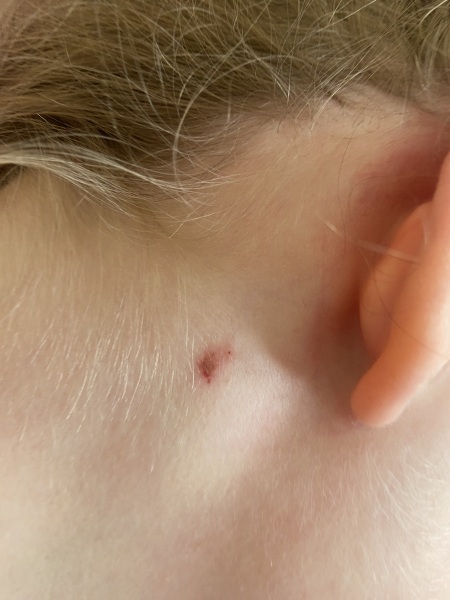 What’s this on my daughter’s neck?