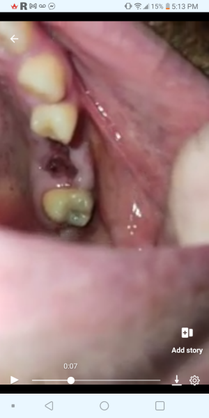 Is this normal for tooth extraction