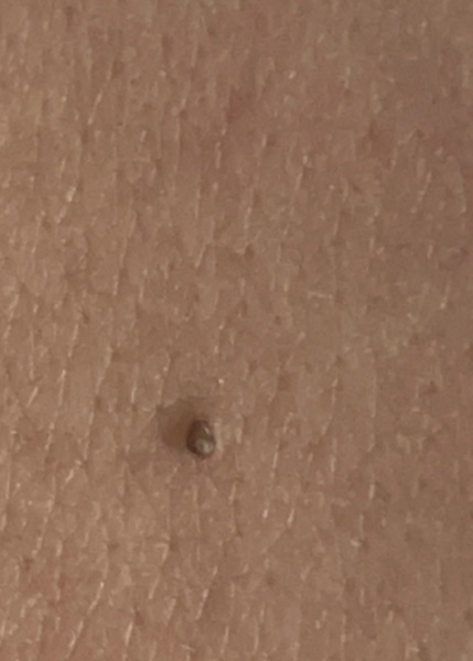 To be worried about this mole?pic attached 
