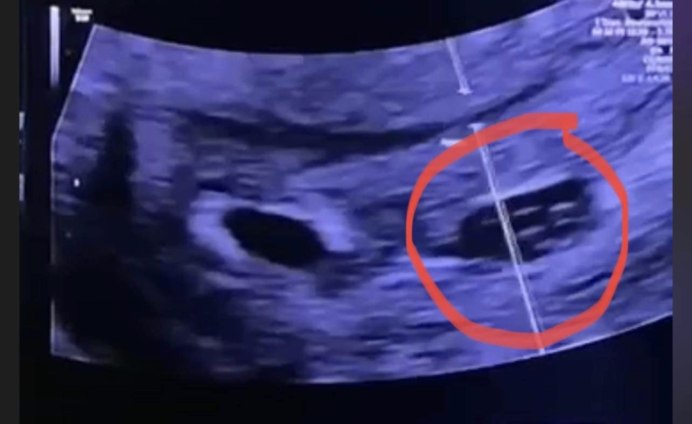 Does this look like potential twins? 5weeks5 ultrasound