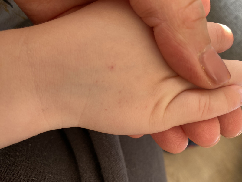 Petechial rash ?