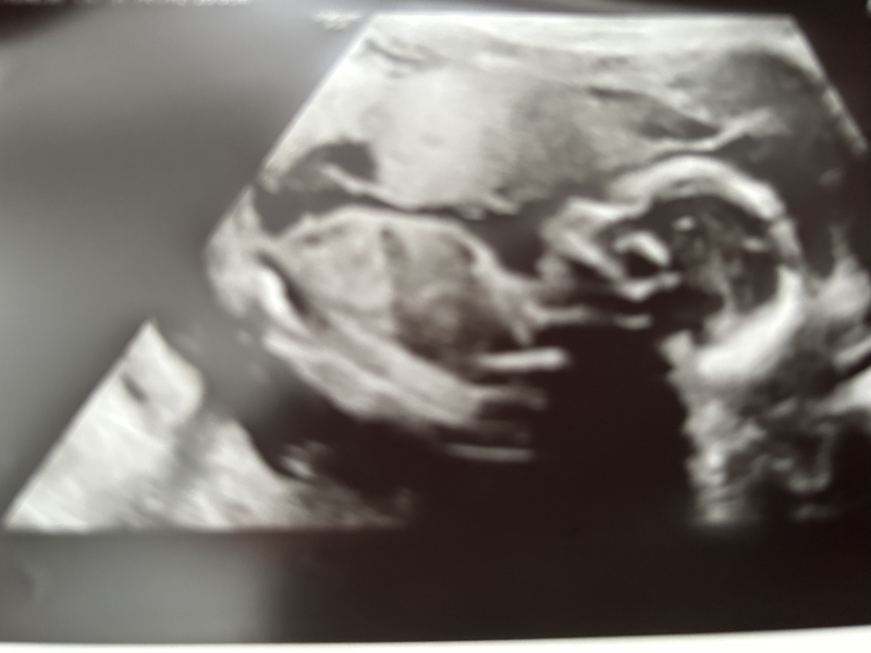 Ivf pregnancy - first trimester