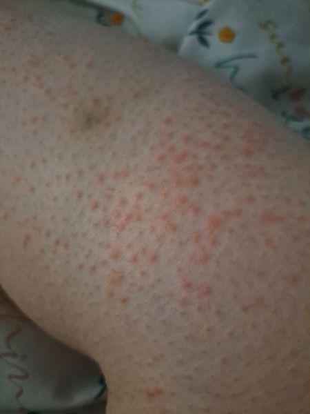 Bruising - Anyone else? Advice?