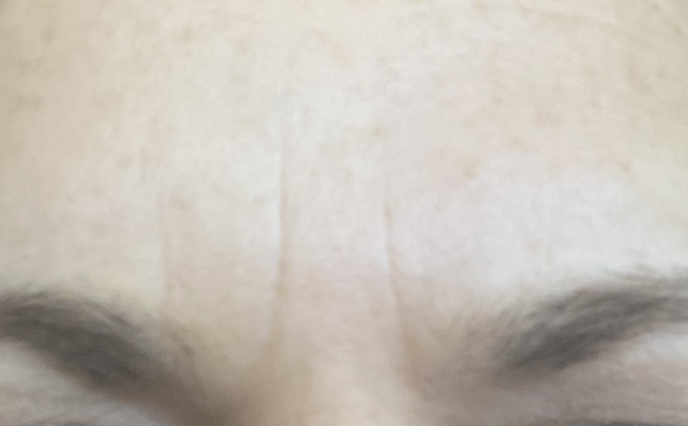 Forehead vertical wrinkles - any advice please?