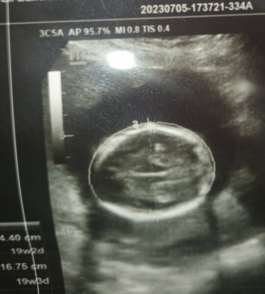 Any scan pictures showing gender?