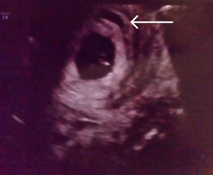 Hematoma and 6 weeks pregnant 