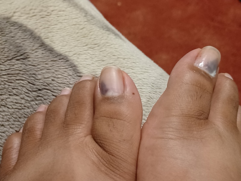 Toenail fungal infection?