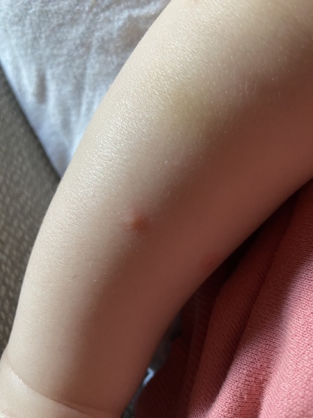 Is this chickenpox? 