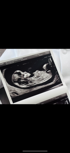 12 week scan - nub/ skull theory 