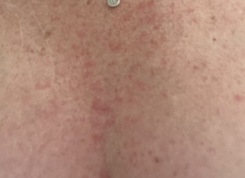 Rash- any ideas? 
