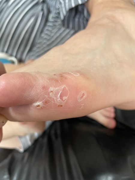 To ask what this is?? (Manky foot alert!)