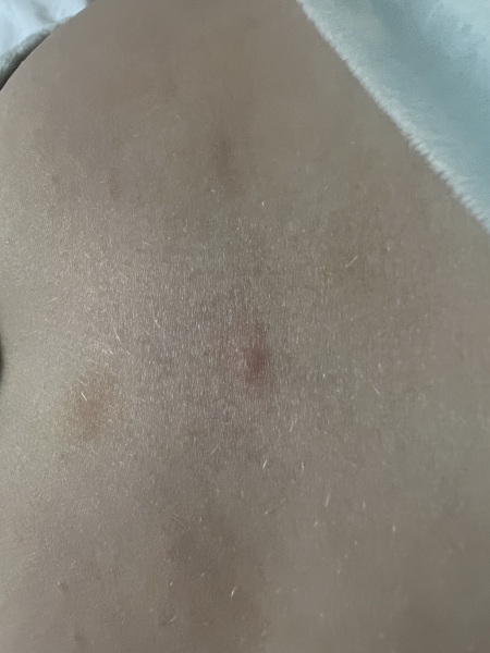 What are these bites??