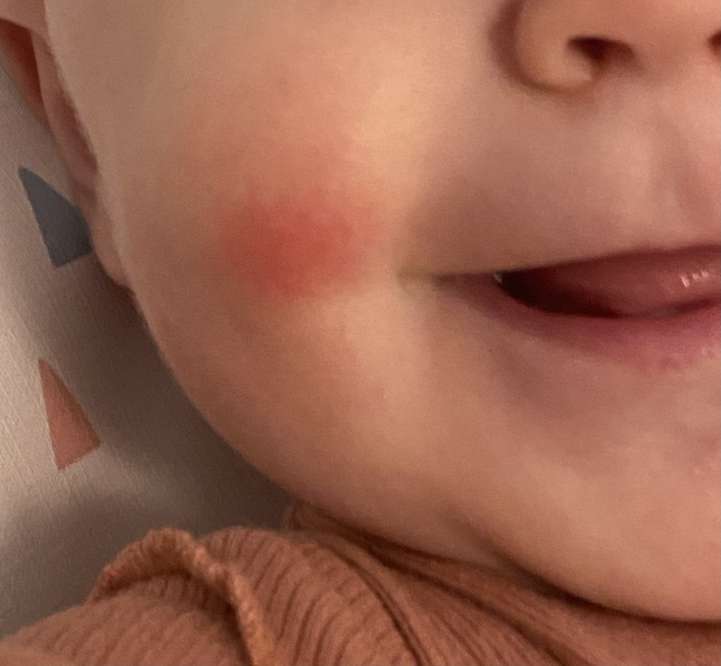 8 month old small red blotch ? Rash on cheek. 