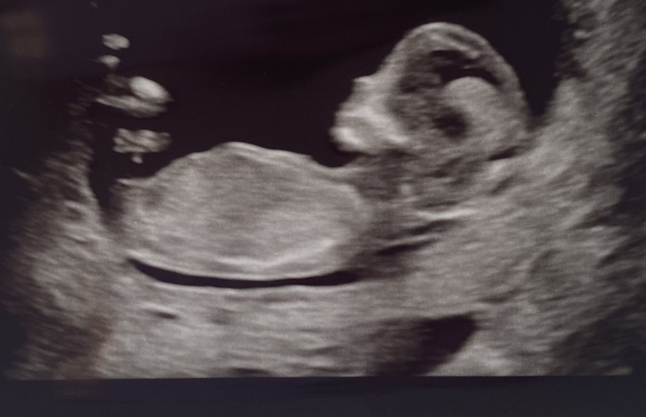 12 week scan - nub/ skull theory 