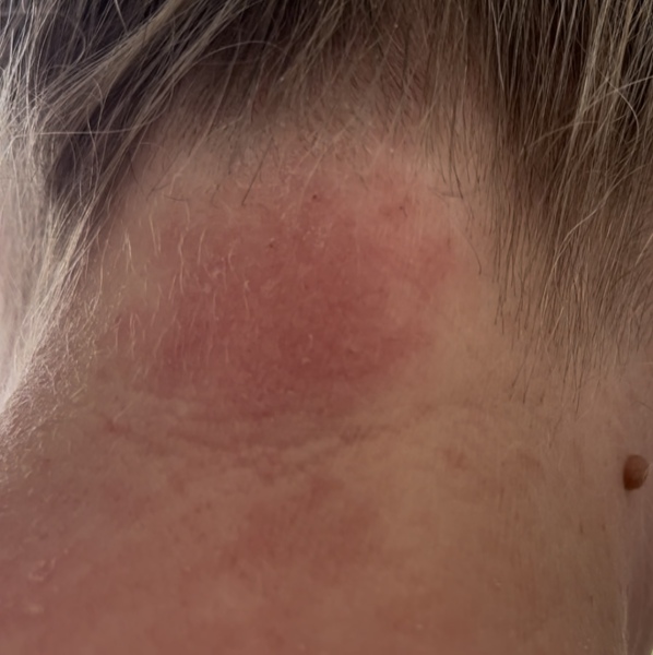 Sertraline and Skin reaction