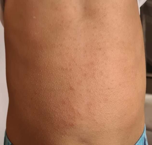 Is this Scarlet Fever?