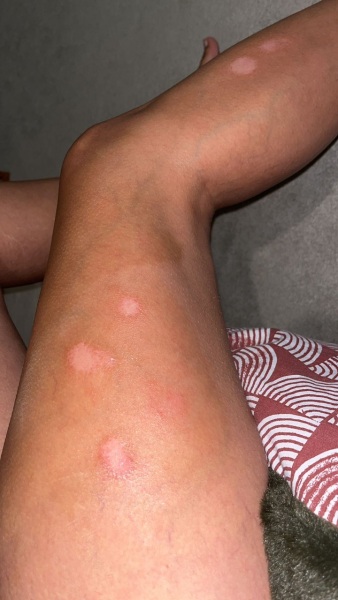 Help please skin patches !!!!