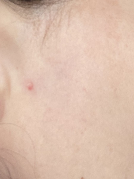Does this look like skin cancer? 