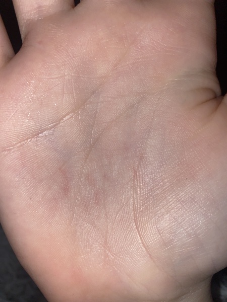 Rash on hands (pic included)